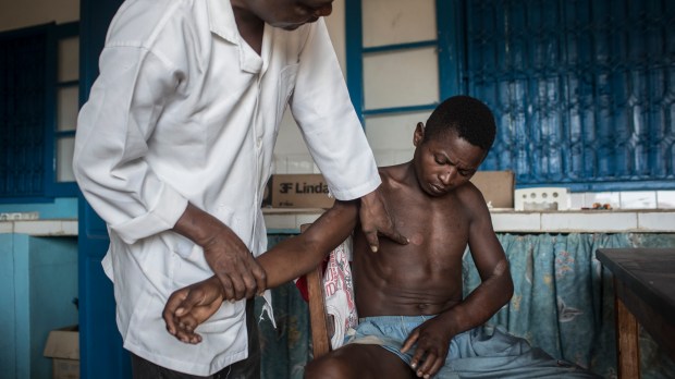 TRAITEMENT DES CAS DE LEPRE DANS UN CENTRE DE SANTE DE L&#8217;EST DE MADAGASCAR, PRES DE MANANJARY.