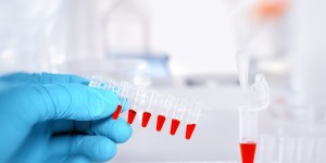 Biomarqueurs : la recherche pourrait changer la vie des personnes porteuses de trisomie 21